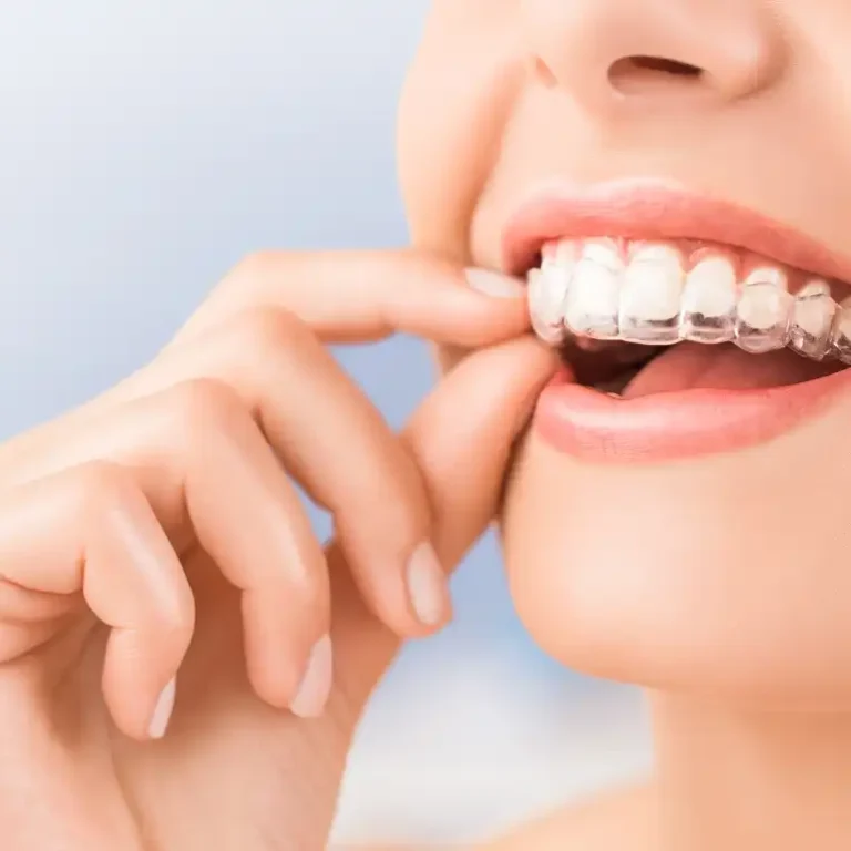 Şeffaf Plak Tedavisi (Invisalign)